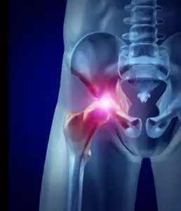 Alternatives to Hip replacement 258x300 1
