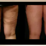 Acoustic Wave Therapy for Cellulite Treatment 2 Acoustic Wave Therapy Before and After