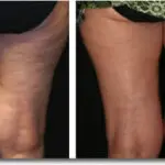 Acoustic Wave Therapy for Cellulite Treatment 1 Acoustic Wave Therapy Before and After