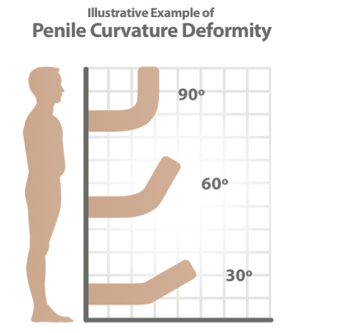 penile curvature deformity