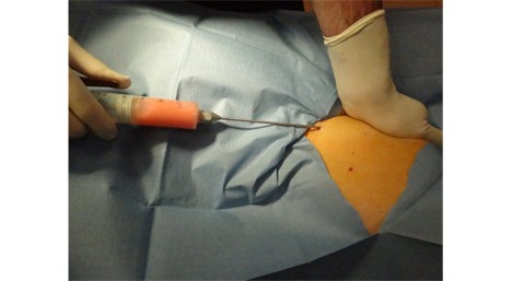 Fat-Derived Stem Cells