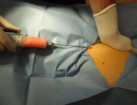 Cells harvested to deliver neuropathic pain relief